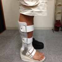 アキレス腱断裂の手術後、歩行用装具に切り替わったときに気をつける7